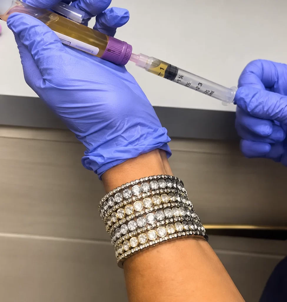 Syringe of PRP drawn for hair restoration treatment
