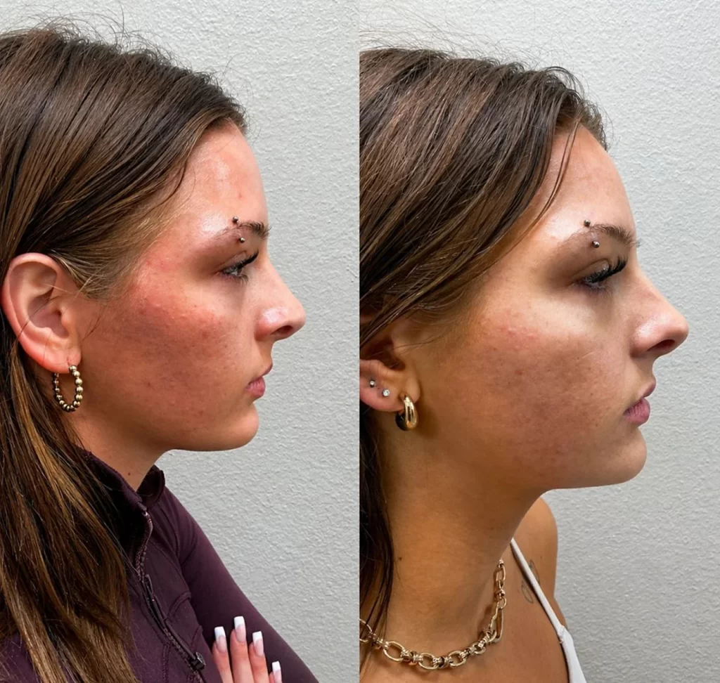 Nose filler before and after, profile view